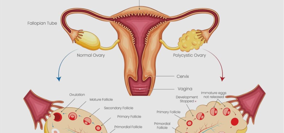 PCOS_PCOD_treatment_at_Praarambh_IVF_Indore_by_Dr_yogita_parihar PCOS PCOD treatment at Praarambh IVF Indore by Dr. Yogita Parihar